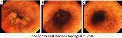 Comparative Efficacy and Safety of Anterograde vs. Retrograde Iodine Staining During Esophageal Chromoendoscopy: A Single-Center, Prospective, Parallel-Group, Randomized, Controlled, Single-Blind Trial